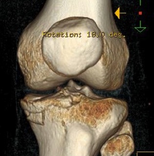 Knee dislocation tibial plateau fracture
